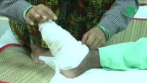 Nhờ thầy lang chữa rắn cắn, bé gái bị hoại tử chân