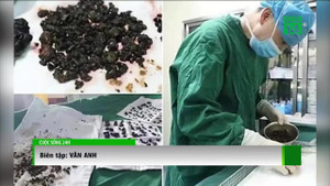 Bác sỹ phẫu thuật gắp gần 300 viên sỏi trong túi mật của người phụ nữ ở Vĩnh Long