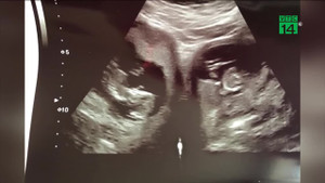 Cặp song sinh nằm ở 2 tử cung: 500 triệu ca mới có 1