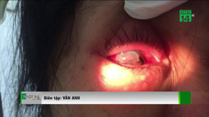 Bị chồng bạo hành đến vỡ nhãn cầu