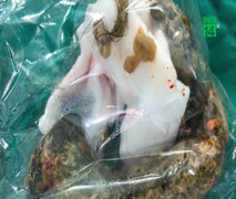 Mắc bệnh công chúa tóc mây, bé gái thích ăn tóc của mình