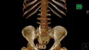 Tưởng bị ung thư, hóa ra có chiếc kéo dài 15cm nằm trong bụng 6 tháng