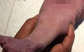 Em bé sinh ra với đôi chân dính chặt như 'nàng tiên cá'