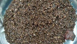 Sửng sốt với người phụ nữ có đến 2.980 viên sỏi thận