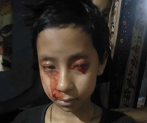 Bệnh lạ khiến bé gái 8 tuổi 'khóc' ra máu