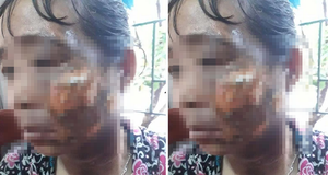 Không được ăn ốc, gã chồng nhẫn tâm hất ấm nước sôi vào mặt vợ