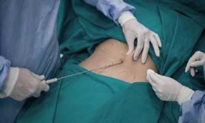 Why can liposuction be fatal?