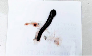 Đỉa ký sinh 10 ngày trong mũi bé gái ở Quảng Nam