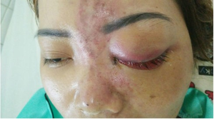 Video: Tiêm filler nâng mũi giá 1,5 triệu đồng, nữ sinh 15 tuổi mù mắt