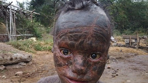 Xót thương cậu bé có biệt danh 'người rắn', phải tắm liên tục mỗi giờ