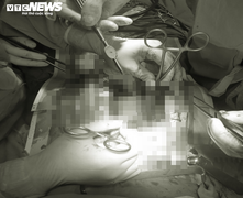 Cứu sống kịp thời người phụ nữ bị vỡ tim do tai nạn giao thông