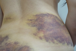 Chồng đánh vợ dã man ở Tây Ninh: Nạn nhân yêu cầu xử lý hình sự