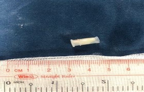 Bé trai 3 tuổi nuốt nguyên chiếc còi đồ chơi, thở tiếng kèn kêu