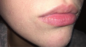 7 dấu hiệu cho thấy bạn đang bị thiếu vitamin A