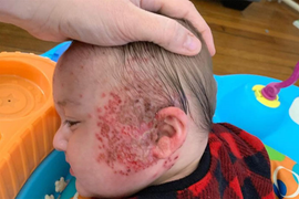 Bé 6 tháng tuổi suýt chết vì một nụ hôn