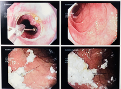 Đi chữa răng, nam thanh niên nuốt phải kim nha khoa