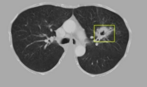 Trí tuệ nhân tạo chẩn đoán ung thư phổi chính xác 96%