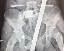 Cứu sống thanh niên bị 2 thanh sắt đâm xuyên ngực nguy kịch