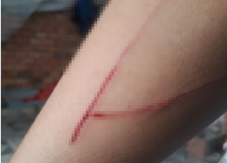 Bé gái 15 tuổi trong vụ án hiếp dâm bị 2 kẻ lạ chặn đường, chém thương tích