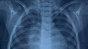 Kim khâu 4cm trong cơ thể bé gái 3 tuổi