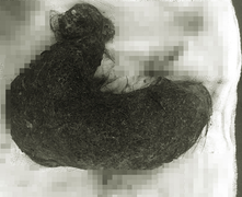 Nuốt tóc suốt 9 năm, bé 11 tuổi có khối u tóc khổng lồ chiếm gần hết dạ dày