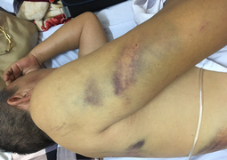 Thầy giáo dạy lái xe ở Hải Dương bị 2 kẻ côn đồ đánh gãy 4 xương sườn