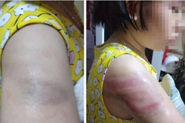 Đánh học sinh bầm tím tay, cô giáo bị đình chỉ hết năm học