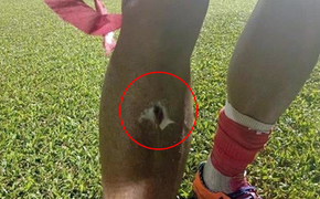 Sau va chạm khiến Hải Huy gãy chân, Hoàng Lâm lộ vết rách tới xương