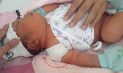 Thai lớn, bác sĩ vẫn cho sinh thường, em bé ra đời bị gãy xương đòn