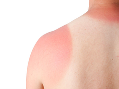 10 nguyên liệu tự nhiên giúp giảm tình trạng cháy nắng