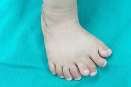 Kỳ lạ: Bàn chân của bé trai có 9 ngón