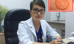 Các bệnh da liễu trẻ hay gặp trong những ngày nắng nóng cha mẹ cần lưu ý