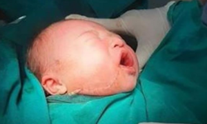 Đẻ tại nhà, bé vừa chào đời bị rách mặt do rơi vào dao cắt rốn