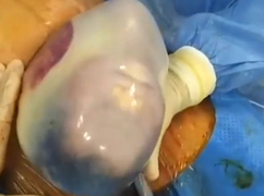 Ngỡ ngàng cặp song sinh chào đời vẫn nằm trong túi ối 