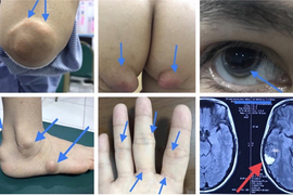 Mắc bệnh di truyền, một gia đình 28 người có thể chết trước tuổi 20