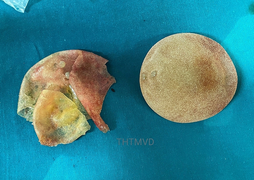 Người phụ nữ vỡ túi ngực silicone mà không hay biết