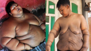 ‘Cậu bé nặng nhất thế giới’ giảm 110 kg nhờ cắt bỏ da thừa