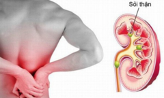 Sỏi tiết niệu: Chủ quan coi chừng mất thận 