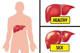 Đầy hơi kéo dài, có thể bạn đang đối mặt với các bệnh nguy hiểm sau