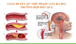 Những sai lầm trong điều trị gây nguy cơ đột quỵ ở người bệnh tăng huyết áp