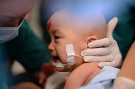 Cặp song sinh dính liền đã tỉnh lại sau ca phẫu thuật tách rời