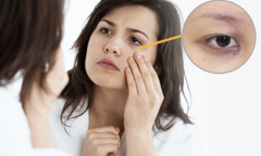 Quầng thâm mắt là dấu hiệu của những bệnh nguy hiểm nào?