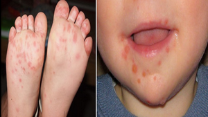 Dấu hiệu nhận biết bệnh tay chân miệng và những khuyến cáo