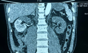 Lấy thận ra khỏi cơ thể để rửa rồi ghép lại cho bệnh nhân