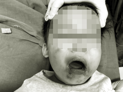 Cắn dây điện khi ngồi chơi, bé gái 2 tuổi ở Yên Bái bất tỉnh, nhập viện khẩn cấp