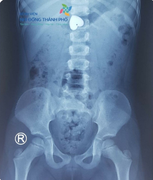 Cầm mặt dây chuyền hình trái tim chơi, bé gái 4 tuổi nuốt luôn vào bụng