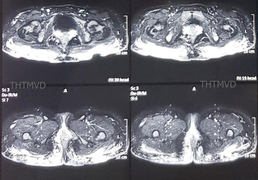 Hoại tử vòng 3 sau khi tiêm mỡ nhân tạo để tăng kích cỡ