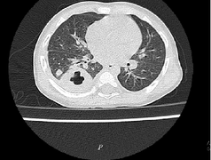 Bé 11 tháng tuổi nhiễm vi khuẩn 'ăn thịt người' Whitmore