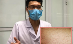 Chuyên gia chỉ rõ những dấu hiệu trên da của bệnh nhân COVID-19
