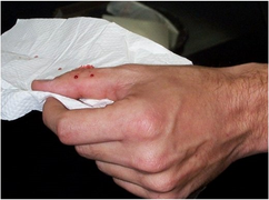 Bị rắn hổ mang chúa cắn, phải sơ cứu thế nào?